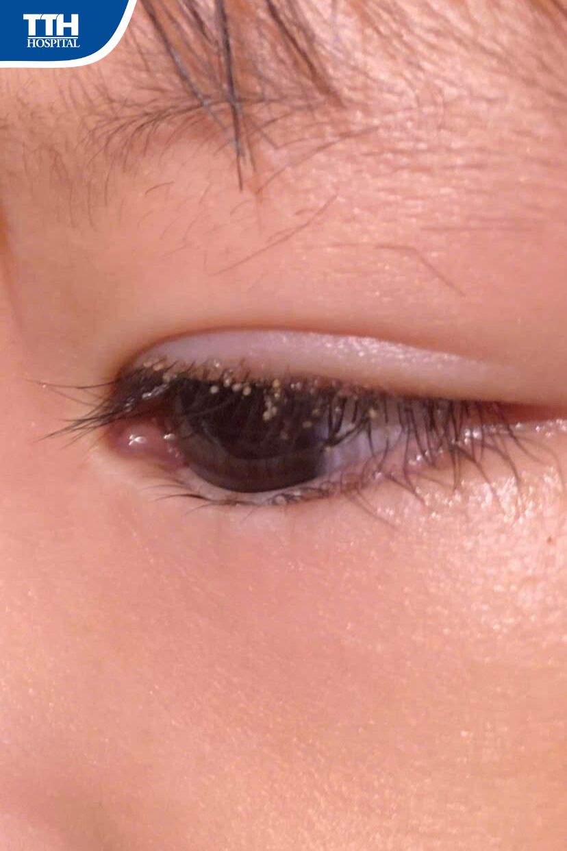 “ĐỘI QUÂN TÍ HON” XẾP HÀNG TRÊN MÍ MẮT - NGUYÊN NHÂN KHIẾN BÉ ĐỎ, NGỨA, SƯNG MÍ!